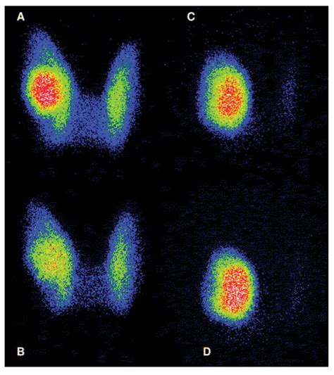 Is there still a role for thyroid scintigraphy in... | F1000Research