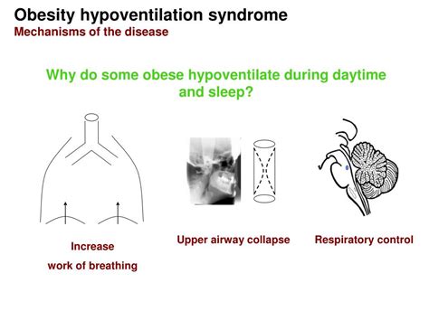 PPT - Sleep-related hypoventilation syndromes PowerPoint Presentation, free download - ID:4725876