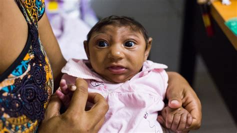 Zika Virus Damages Babies' Brains After Birth, Doctors Report - NBC News