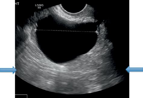 Pelvic Ultrasound Ovarian Cancer