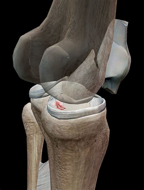 Do The Twist: A Look at a Torn Meniscus