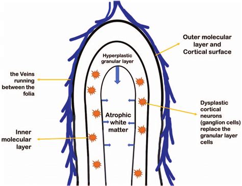 Schematic diagram of the pathology of Lhermitte-Duclos disease ...