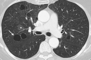 Lung cysts