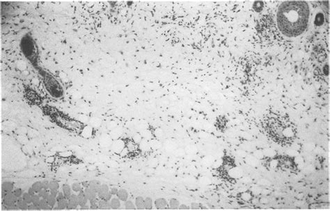 Histology of the Arthus reaction in skin, treated with PBS (positive ...