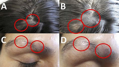 Cureus | Systemic Lupus Erythematosus Presenting as Alopecia Areata