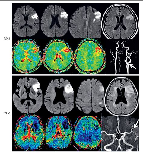 Figure 1 from Transcortical Sensory Aphasia after Left Frontal Lobe ...