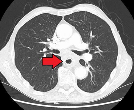 Fosamax Side Effects - Femur Fractures, Esophagus Problems & More