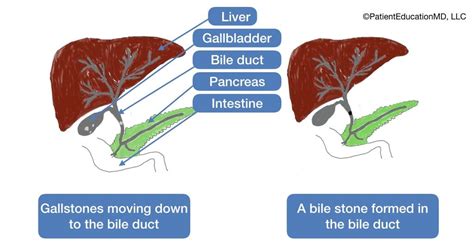 Stones in the Bile Duct | Bile duct, Duct, Bile stone