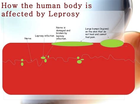 Leprosy