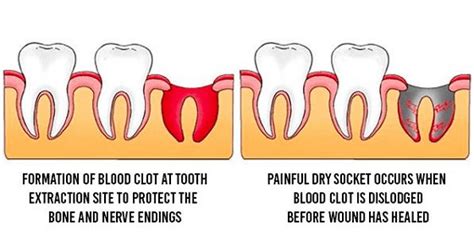 Dry Socket: Causes, Symptoms, & Treatments