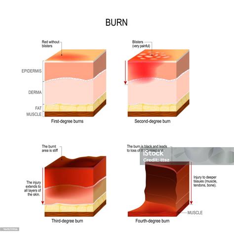 Skin Burn Four Degrees Of Burns Stock Illustration - Download Image Now ...