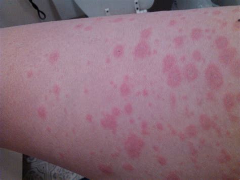 prednisone rash