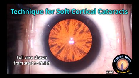 Cortical Cataract