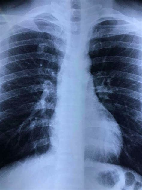 Hamartoma | Radiology, Ultrasound, X ray