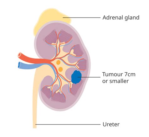 Kidney cancer staging - Libre Pathology