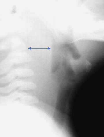 Stridor in the Pediatric Patient | Semantic Scholar