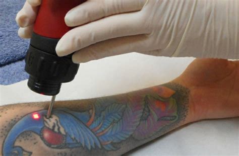 Laser Pigmentation Removal - Tattoo Removalist Brisbane