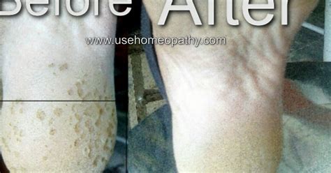 Pitted Keratolysis Homeopathic Treatment « Use Homeopathy And Be Healthy