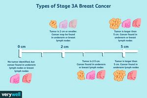 Stage 3 Breast Cancer: Types, Treatment, Survival