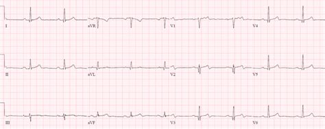 Hyperacute T waves and Occlusion MI | ECG Cases| Emergency Medicine Cases