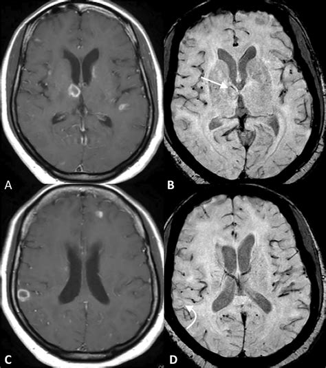 Multiple ring-enhancing lesions in a patient with toxoplasmosis are... | Download Scientific Diagram