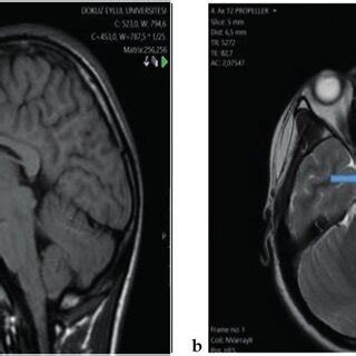 MRI brain scans of patient number 7. a. Midsagittal T1-weighted image ...