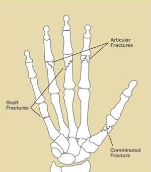 Hand Fractures | UConn Musculoskeletal Institute