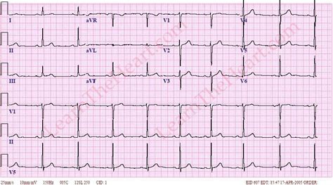 Sinus Bradycardia ECG 3 | LearntheHeart.com