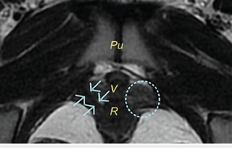 Axial view of the left anterior puborectalis muscle defect Blue arrow:... | Download Scientific ...