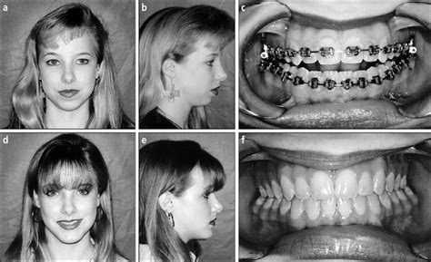 aly roads: Idiopathic Condylar Resorption