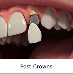 Post Crowns, Dentists Glasgow, NHS and Prive Dentists, Teeth Whitening Glasgow