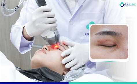 Scar Removal Laser - Bangkok Aesthetic Clinic