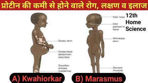 Kwashiorkor Pathogenesis