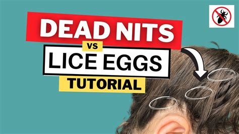 Dead Nits vs Live Lice Eggs Video Tutorial - YouTube