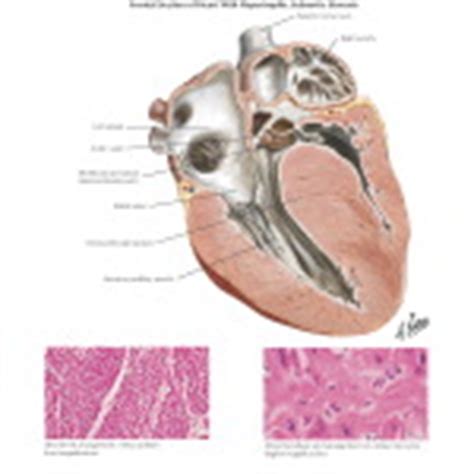 Idiopathic Hypertrophic Subaortic Stenosis: Hypertrophic Cardiomyopathy