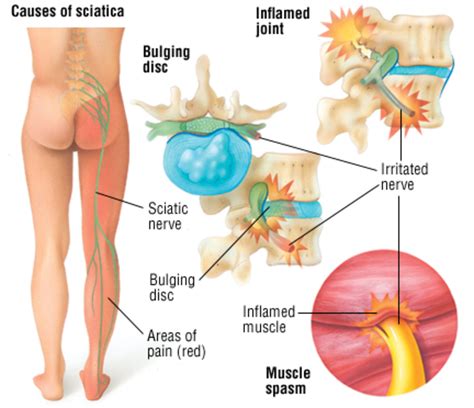 Sciatica - Causes, Symptoms, and Treatment - HubPages