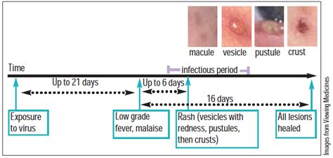 Chickenpox and shingles infection - The Pharmaceutical Journal