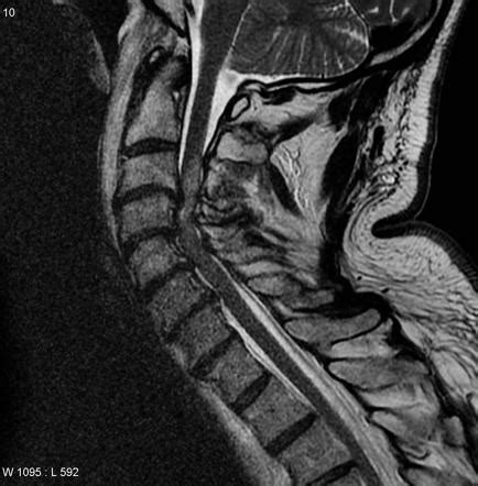 Central Cord Syndrome Mri