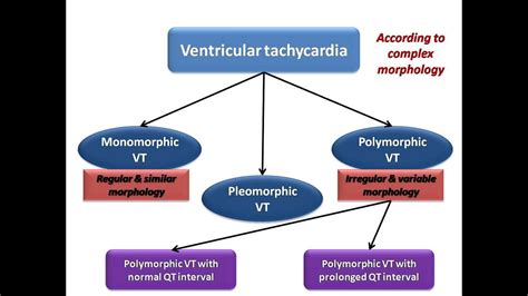 Polymorphic Ventricular Tachycardia Ecg