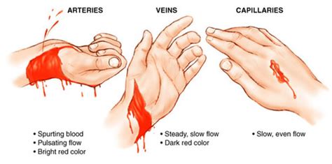 Arterial Bleeding Flashcards | Quizlet