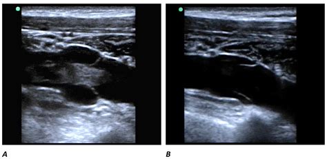 Incidental catheter-associated upper extremity deep venous thrombosis detected by point-of-care ...