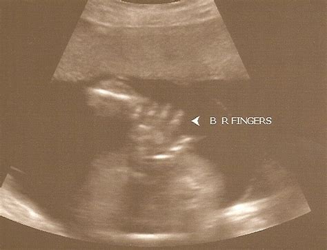 What a trip - The ES Triplets: The big 21 week anomaly ultrasound