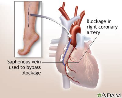 Heart bypass surgery - series—Procedure, part 2: MedlinePlus Medical ...