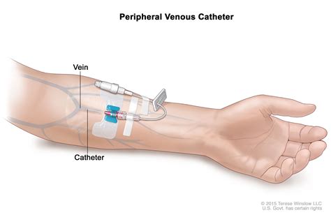 Intravenous Line