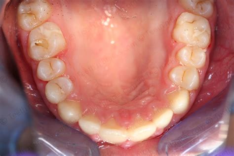 Case 36: Protruded anterior Teeth | Teeth N Braces