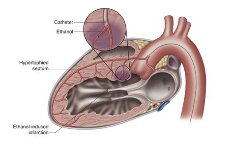 Hypertrophic Cardiomyopathy Treatment