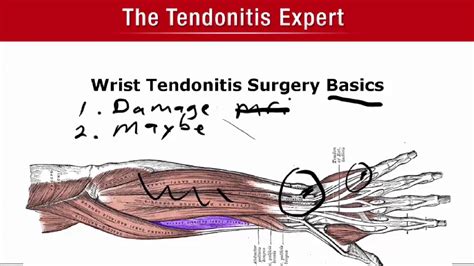 Wrist Tendonitis Surgery Basics - Better To Know Now Than Later - YouTube