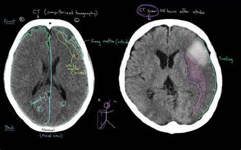 Cat Scan Vs Mri For Stroke - PRAKJY