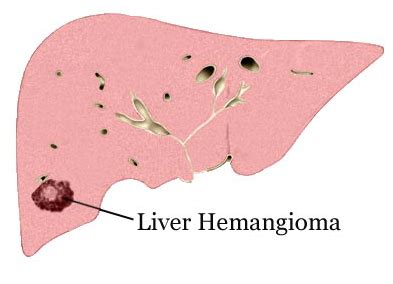 Hemangioma Of The Liver - Dr Sandra Cabot MD