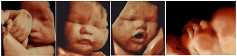 Fetal Ultrasound Scan Of The Third Trimester 33C